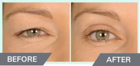 Instant Eye Lift