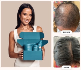 MDhair - Effective Hair Regrowth Tailored to You